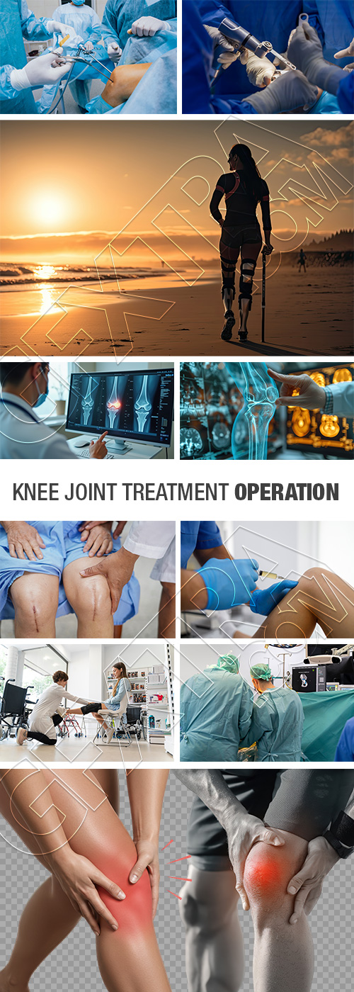 Knee Joint Treatment - Operation 28xJPEG, 4xPNG