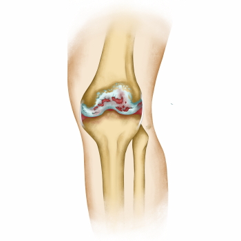 Knee Joint Treatment - DIAGNOSIS 28xJPEG, 7xPNG