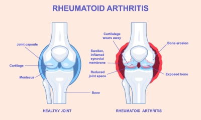 Knee Joint Treatment VECTORS 26xAI
