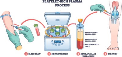 Knee Joint Treatment VECTORS 26xAI