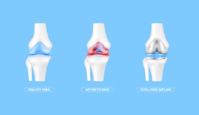 Knee Joint Treatment VECTORS 26xAI