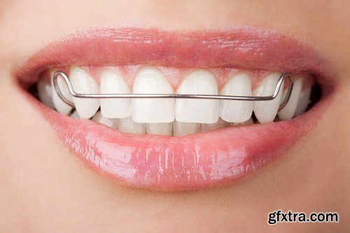 teeth with whitening tray 7X JPEG