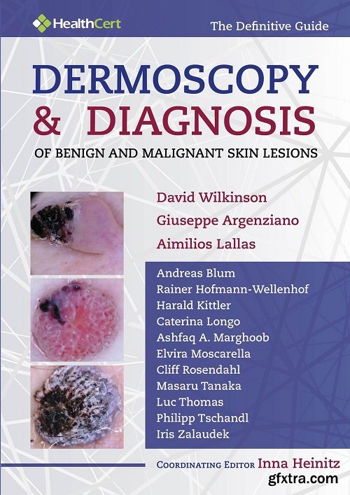 Dermoscopy & Diagnosis of Benign and Malignant Skin Lesions