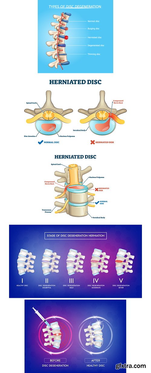 Herniated Disc Set 37xJPG, 10xAI &amp; 1xINDT