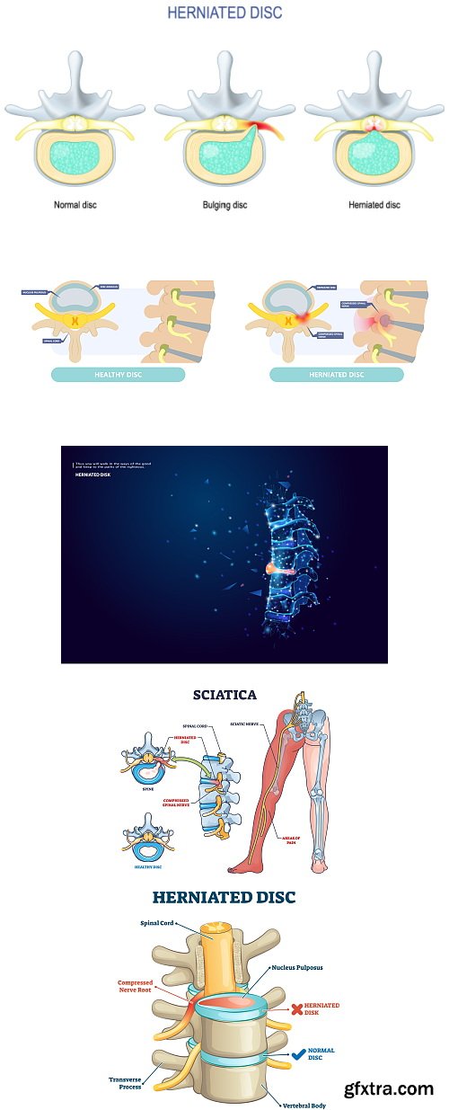 Herniated Disc Set 37xJPG, 10xAI &amp; 1xINDT