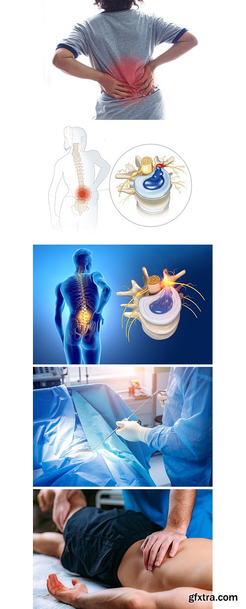 Herniated Disc Set 37xJPG, 10xAI &amp; 1xINDT